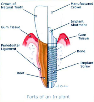 Implant